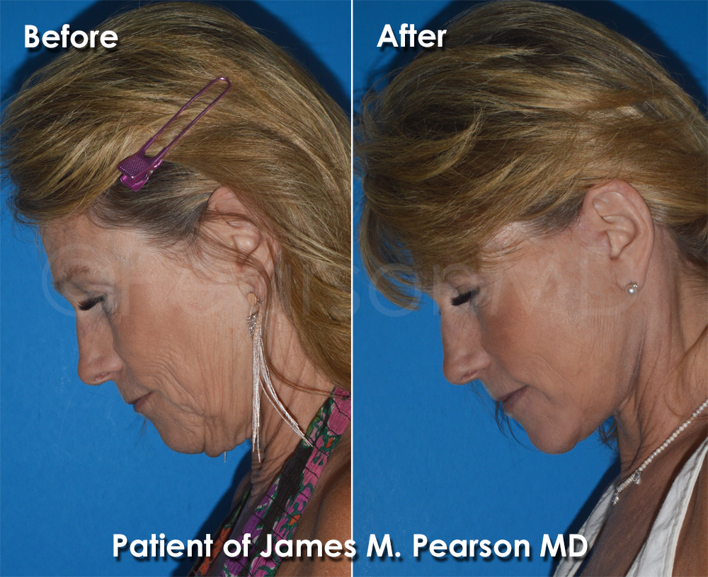 Pearson Plastic Surgery
