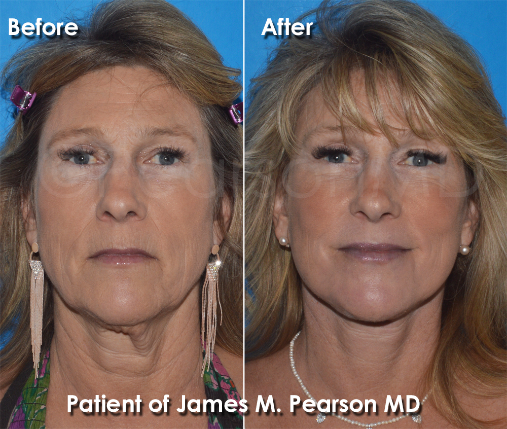 Facelift - Pearson Plastic Surgery