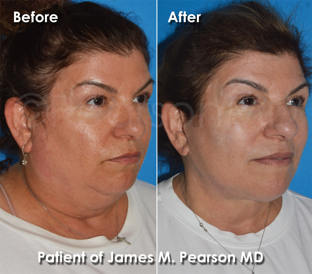 Facelift Dr. Pearson Plastic Surgery