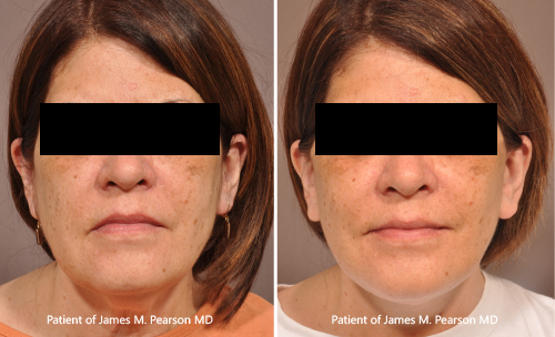 Photos Lower Facelift Dr. Pearson Photos Pearson Facelift