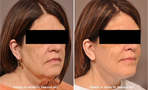 Photos Lower Facelift Dr. Pearson Photos Pearson Facelift