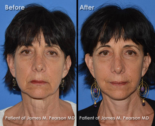 Photos Facelift Dr. James Pearson Facial Plastic Surgery Pearson Facelift Photos