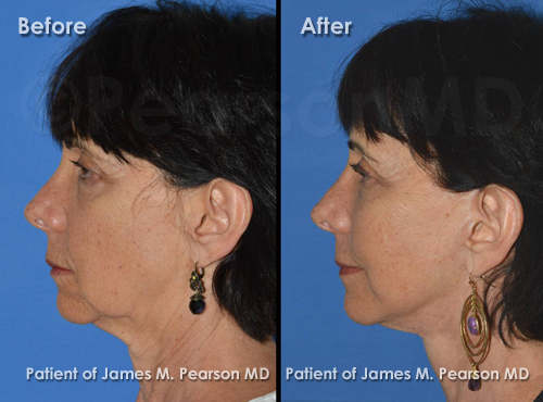 Photos Facelift Dr. James Pearson Facial Plastic Surgery Pearson Facelift Photos
