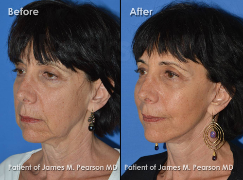 Photos Facelift Dr. James Pearson Facial Plastic Surgery Pearson Facelift Photos