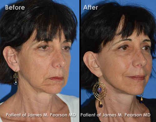 Photos Facelift Dr. James Pearson Facial Plastic Surgery Pearson Facelift Photos
