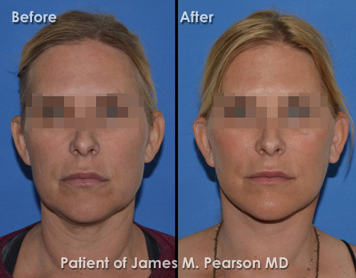 Photos Pearson Redondo Beach Facelift