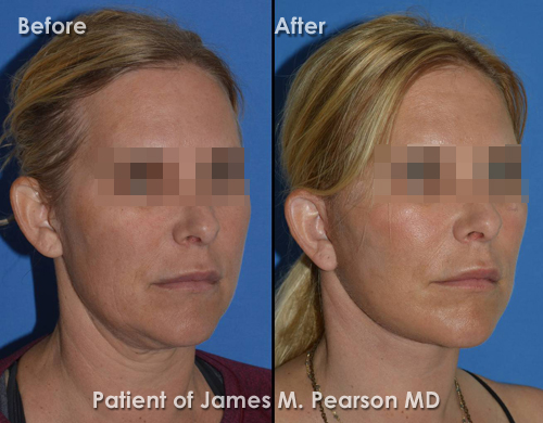 Photos Pearson Hermosa Beach Facelift