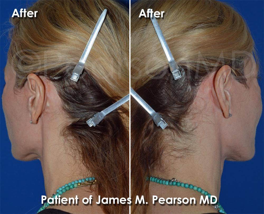 Pearson Facelift