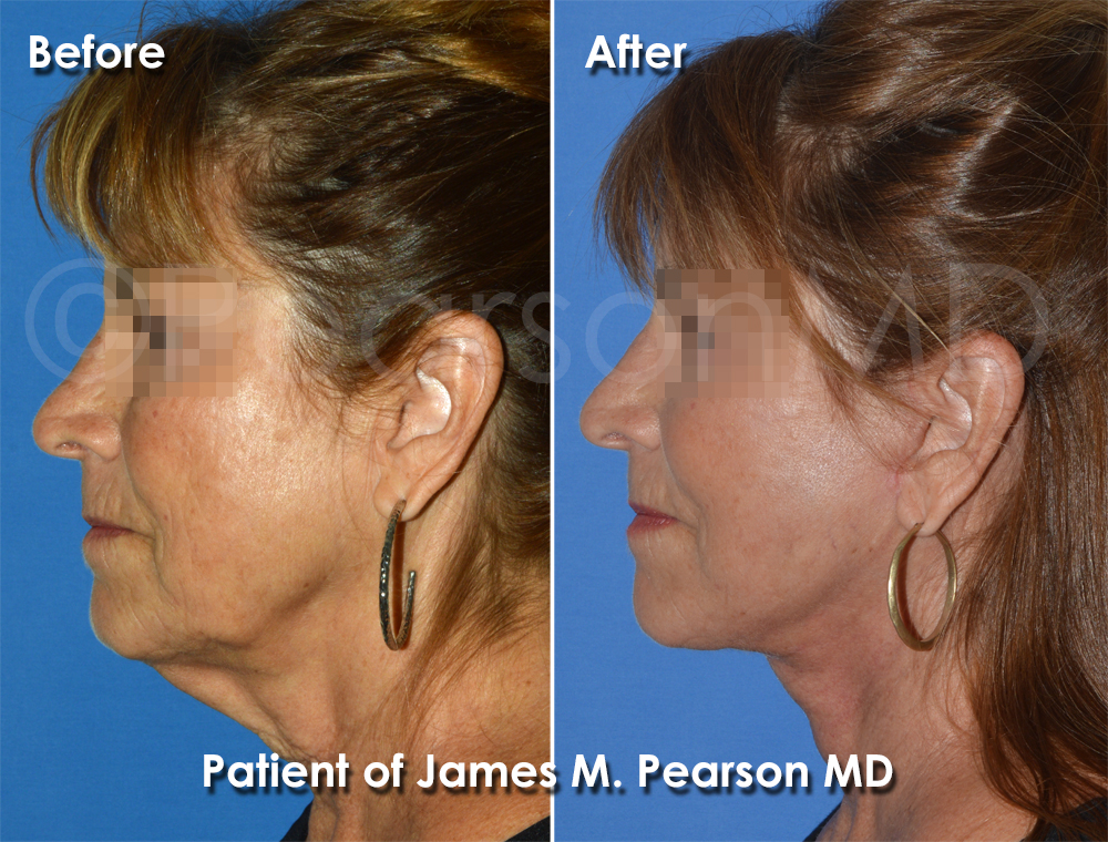 Dr. Pearson Facelift
