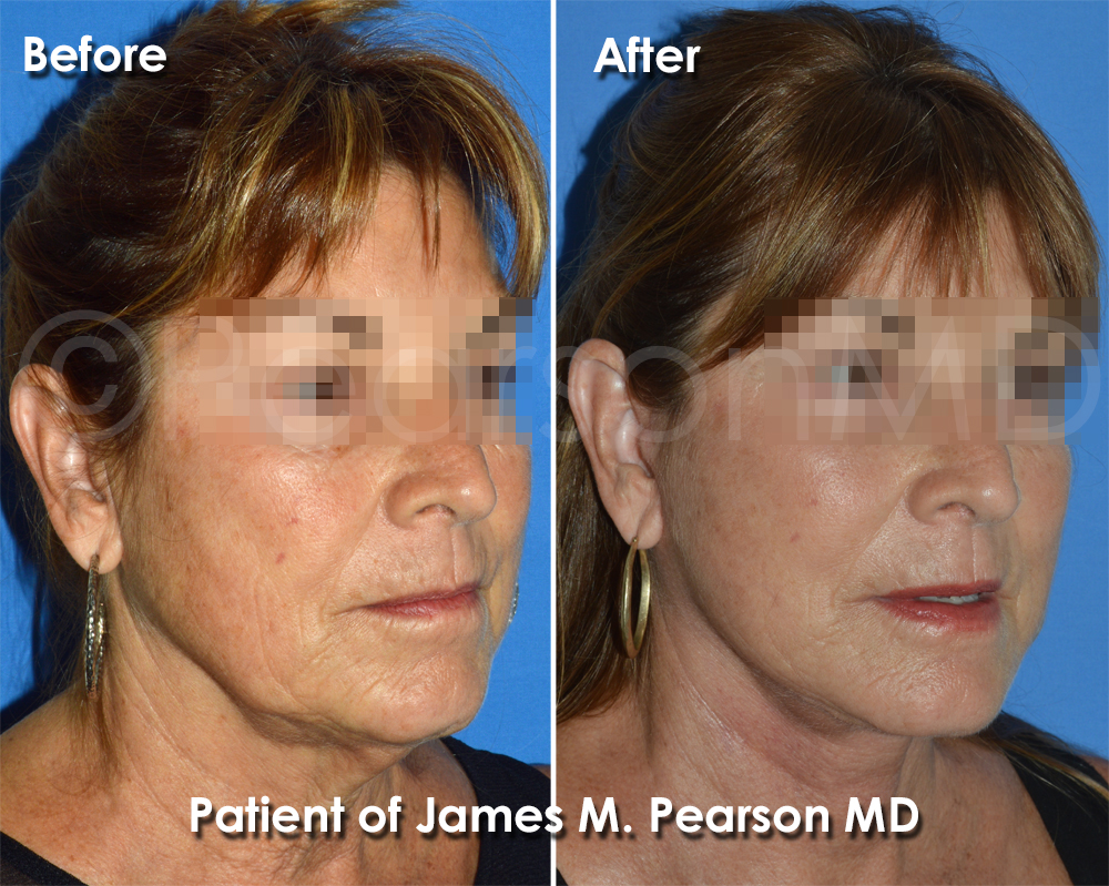 Pearson Facelift