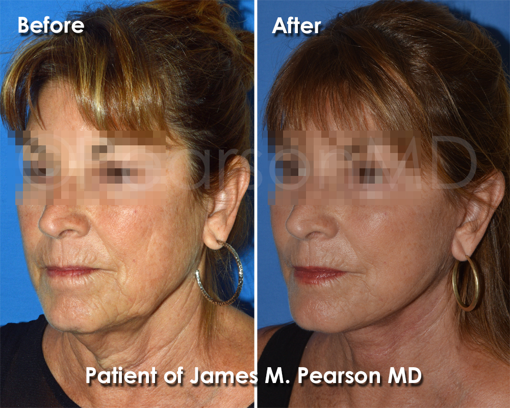 Dr. Pearson Facelift