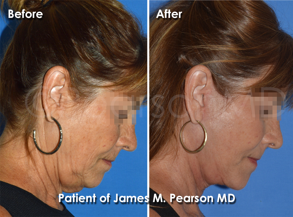 Dr. Pearson Facelift