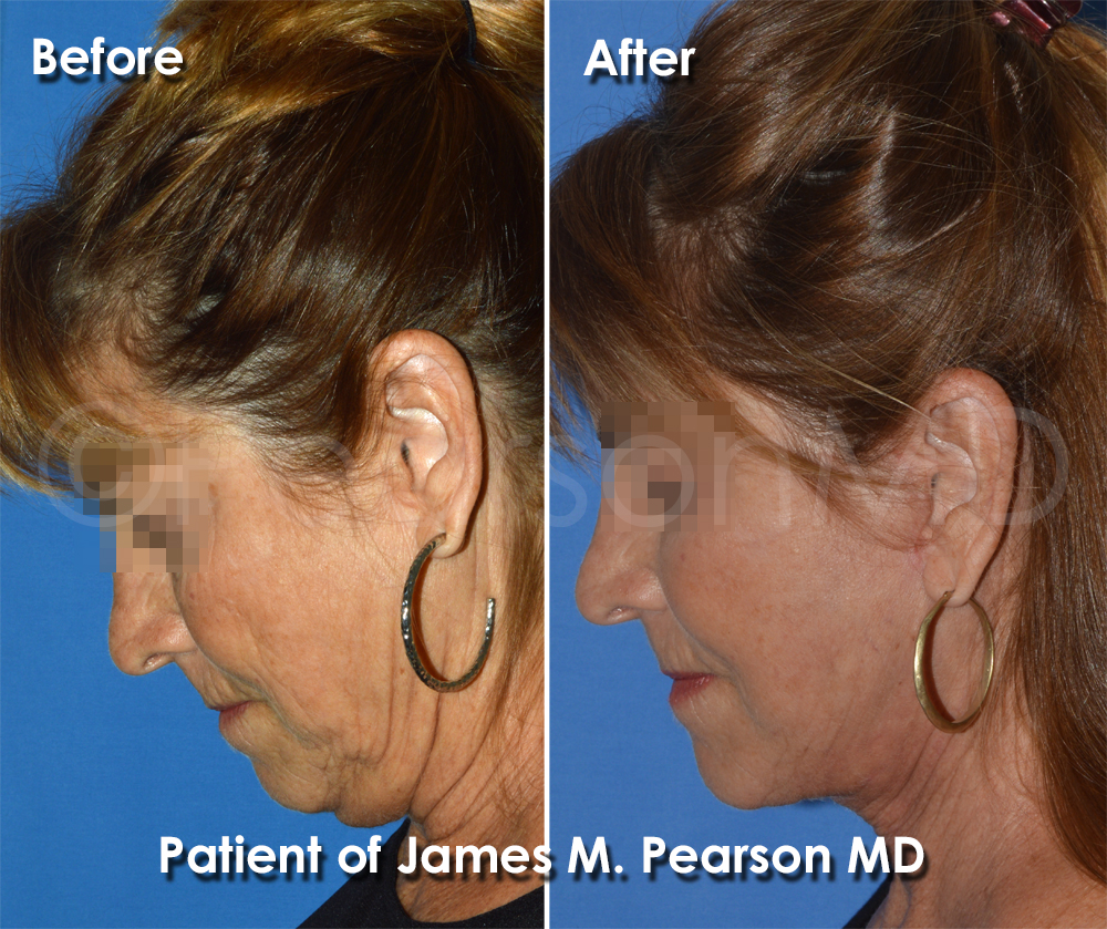 Dr. Pearson Facelift