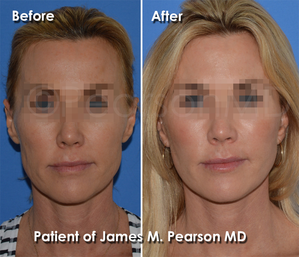 Manhattan Beach Facelift