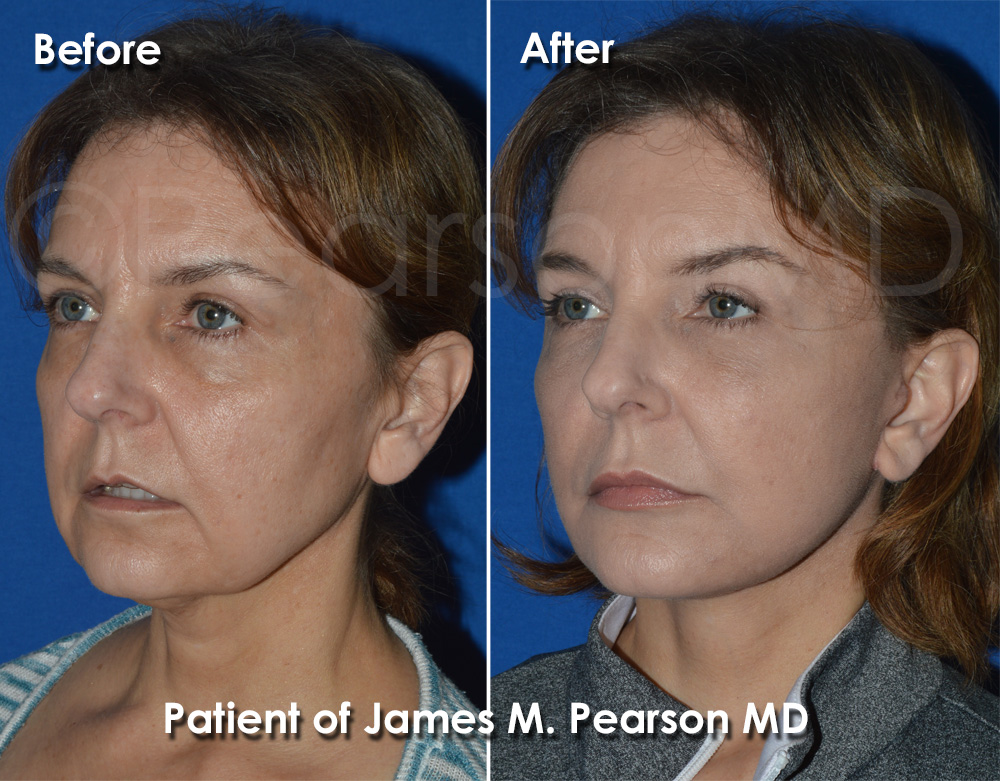 Dr. Pearson Facelift