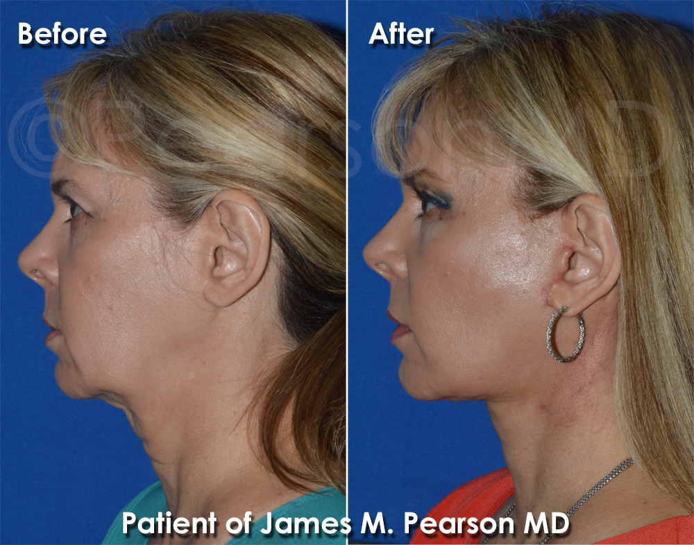 Dr. Pearson Facelift