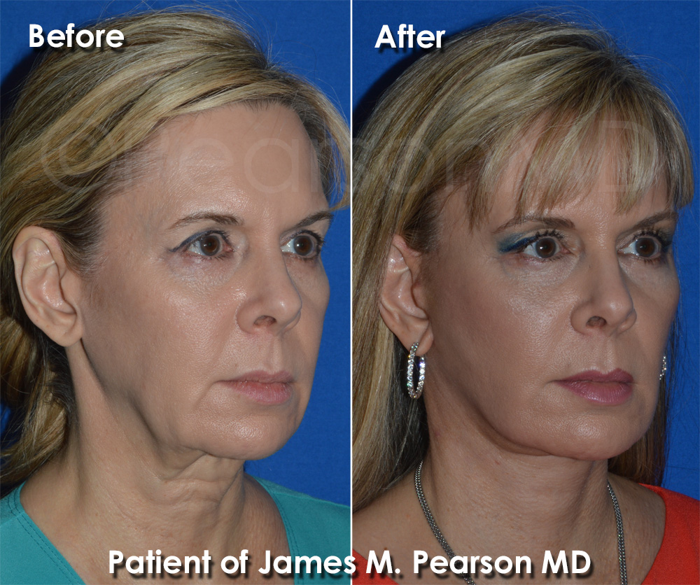 Hermosa Beach Facelift