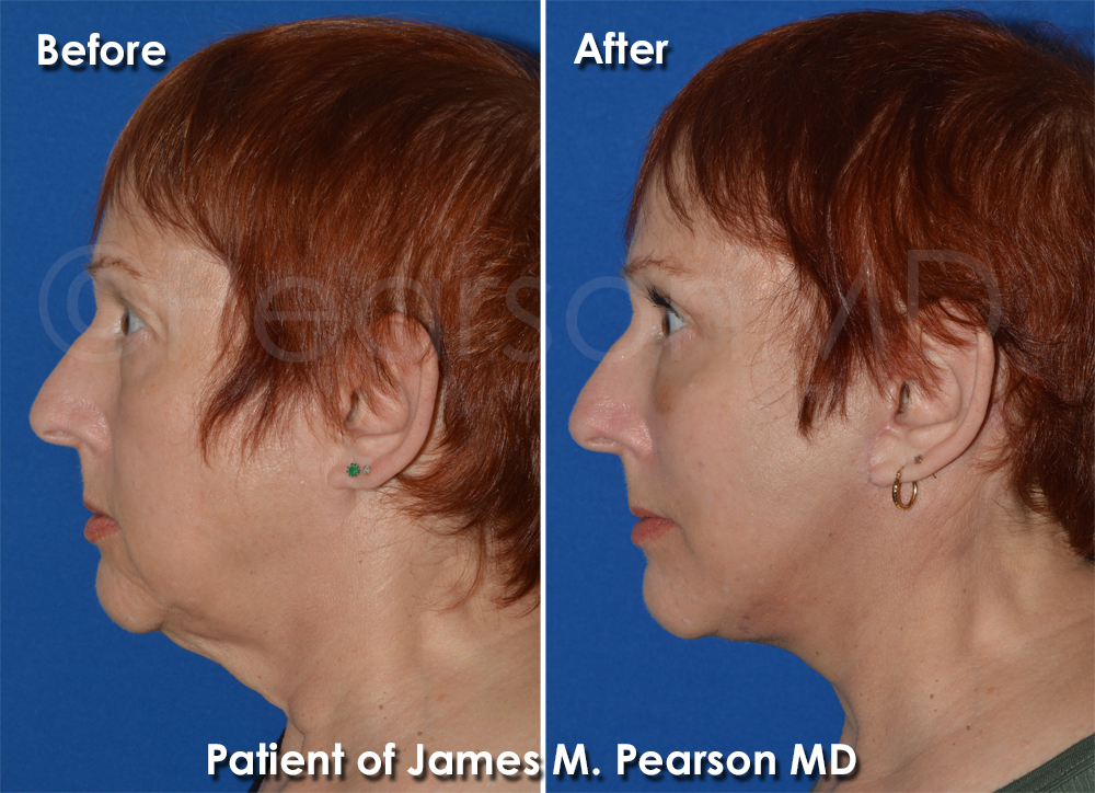 Pearson Facelift