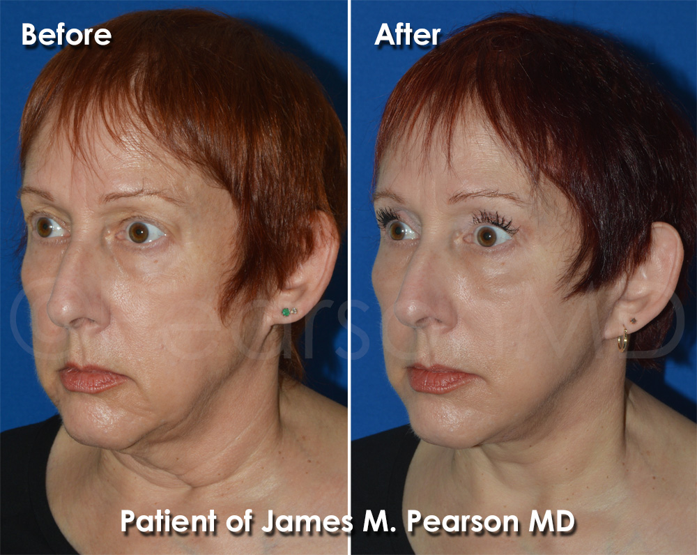 Pearson Facelift