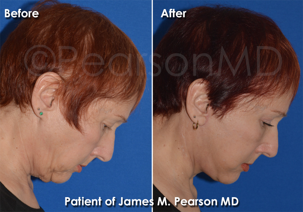 Dr. Pearson Facelift