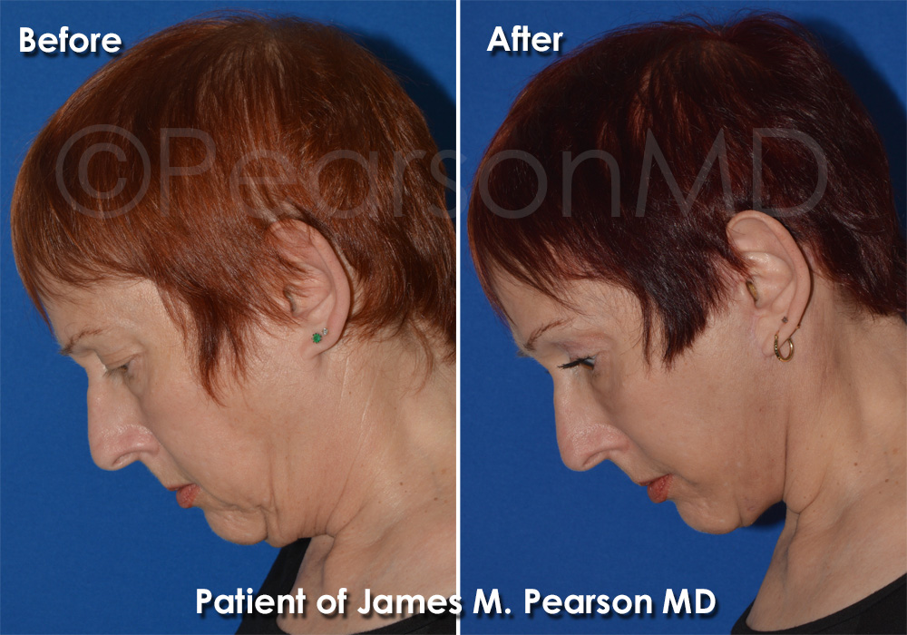 Dr. Pearson Facelift