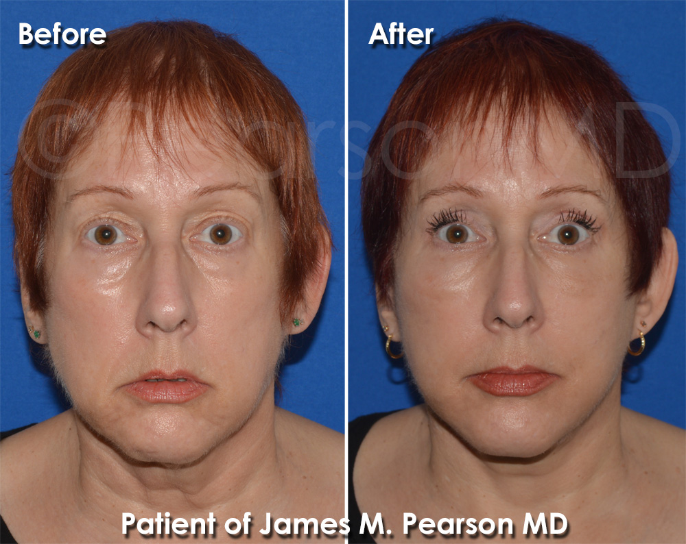 Pearson Facelift