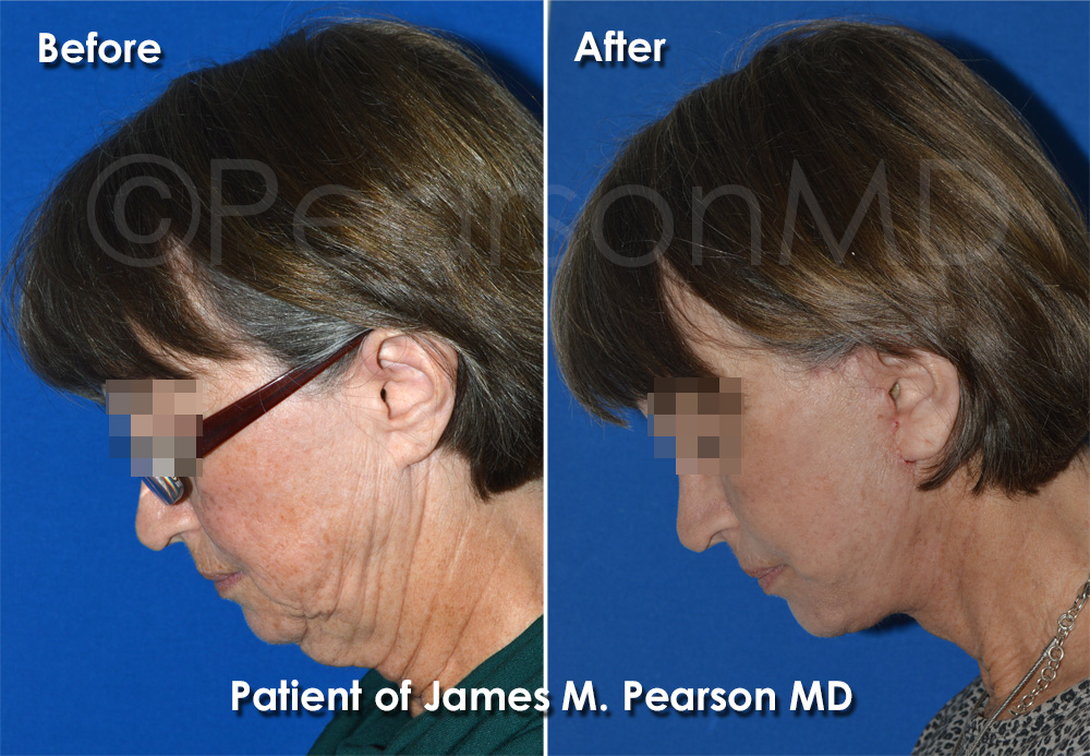 Photo Beverly Hills Facelift Dr. James Pearson Facial Plastic Surgery Pearson Plastic Surgery