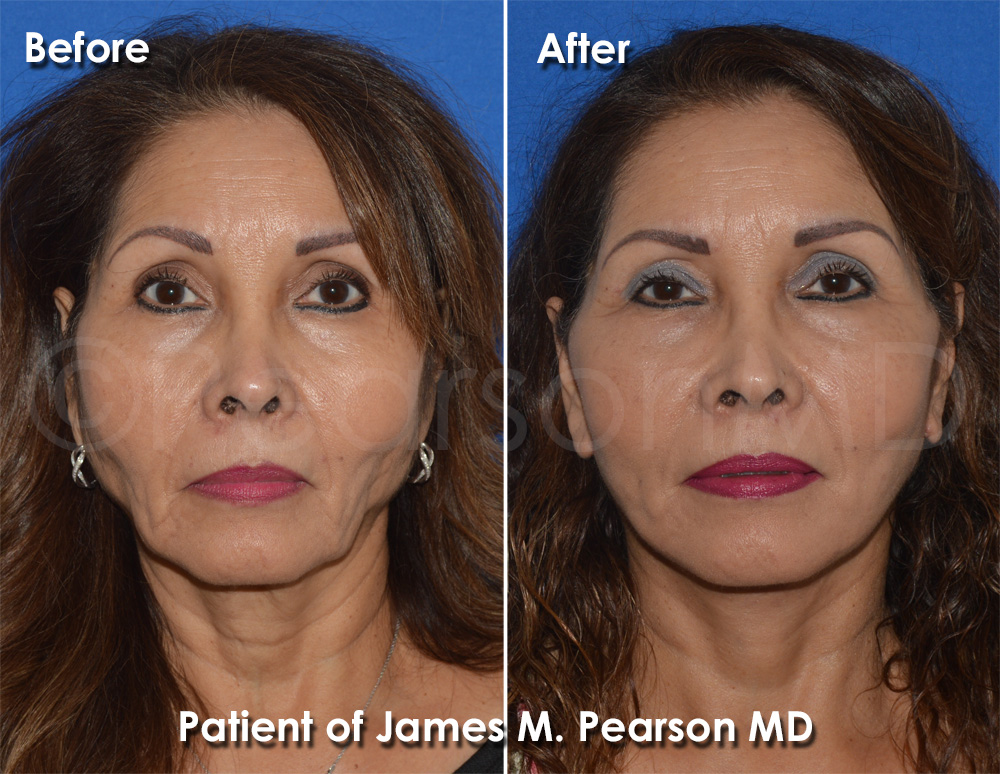 Dr. Pearson Facelift
