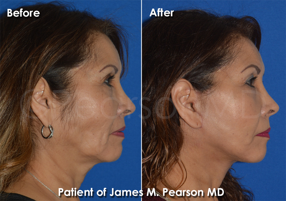 Redondo Beach Facelift