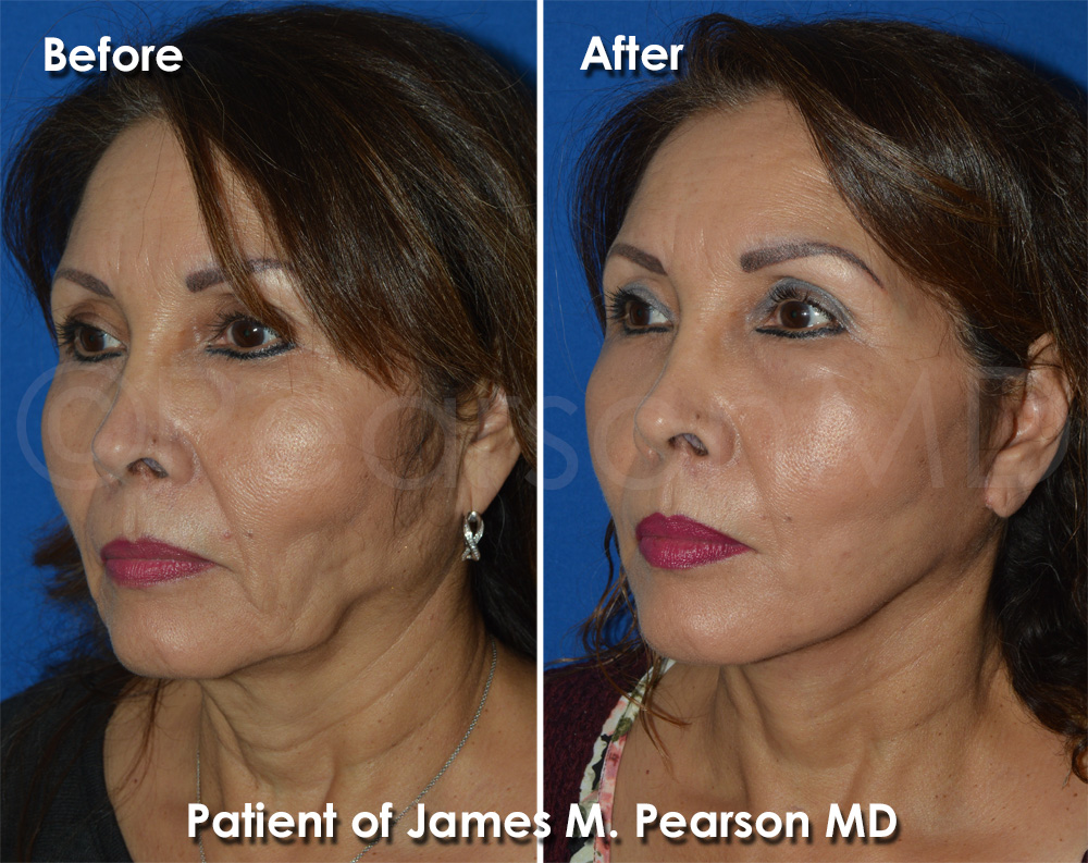 Beverly Hills Facelift