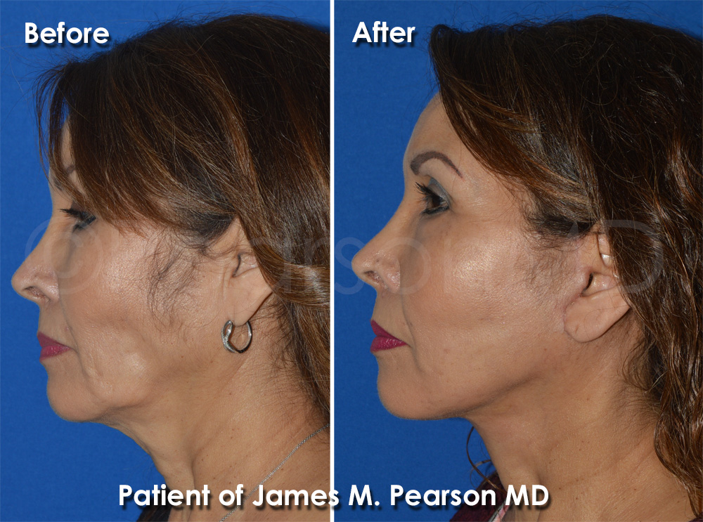 Pearson Plastic Surgery