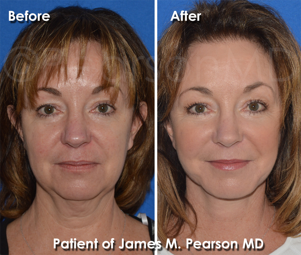 Pearson Facelift