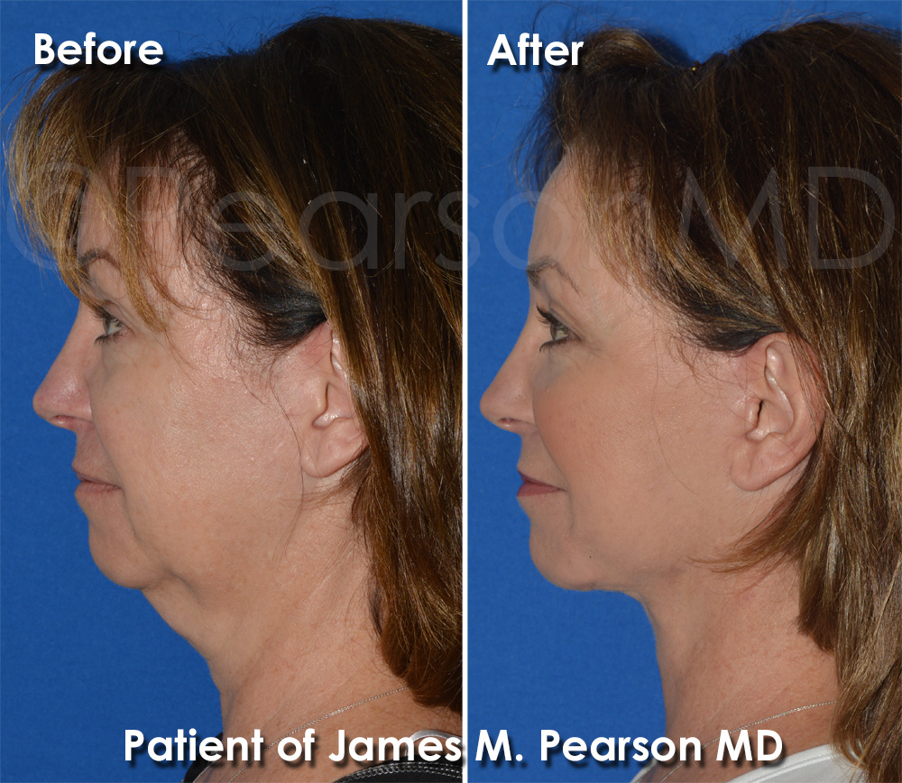 Dr. Pearson Facelift