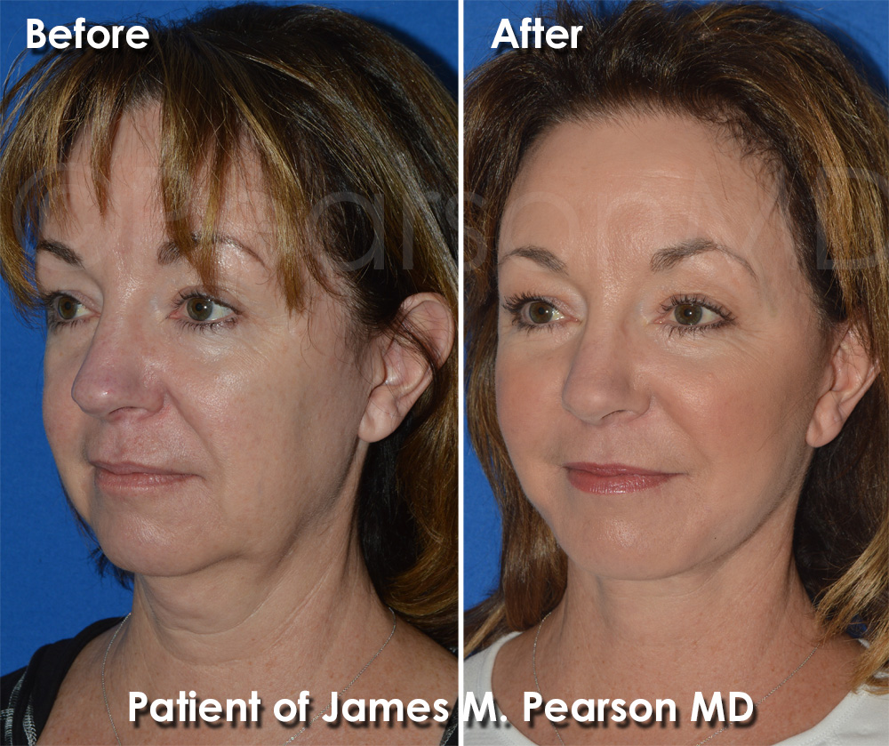 Pearson Plastic Surgery
