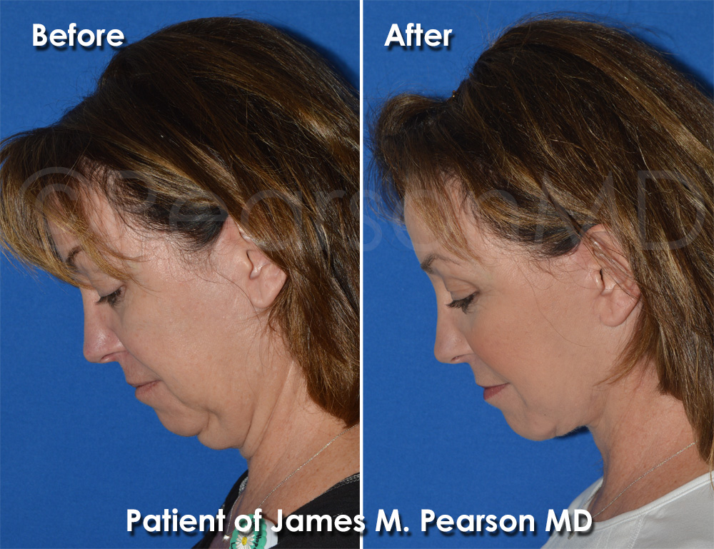 Dr. Pearson Facelift