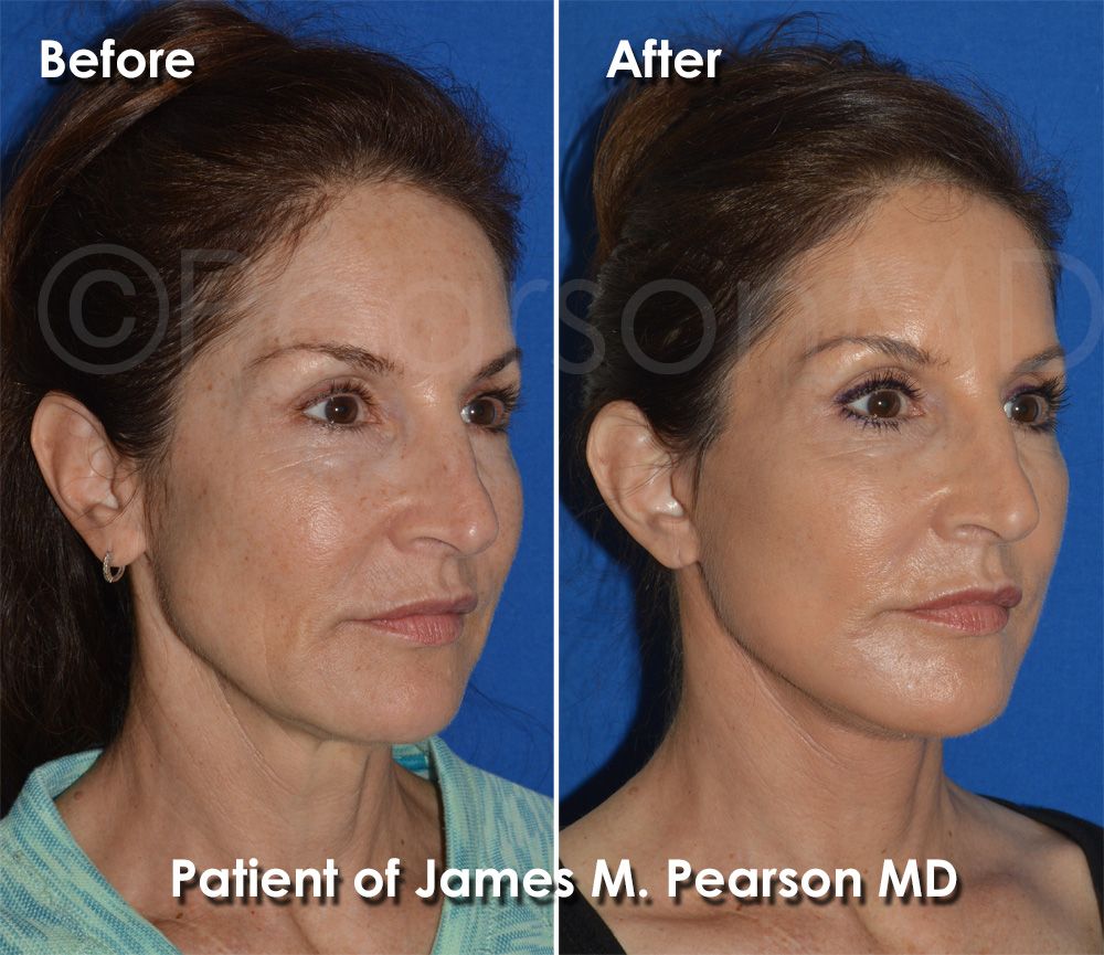Dr. Pearson Facelift