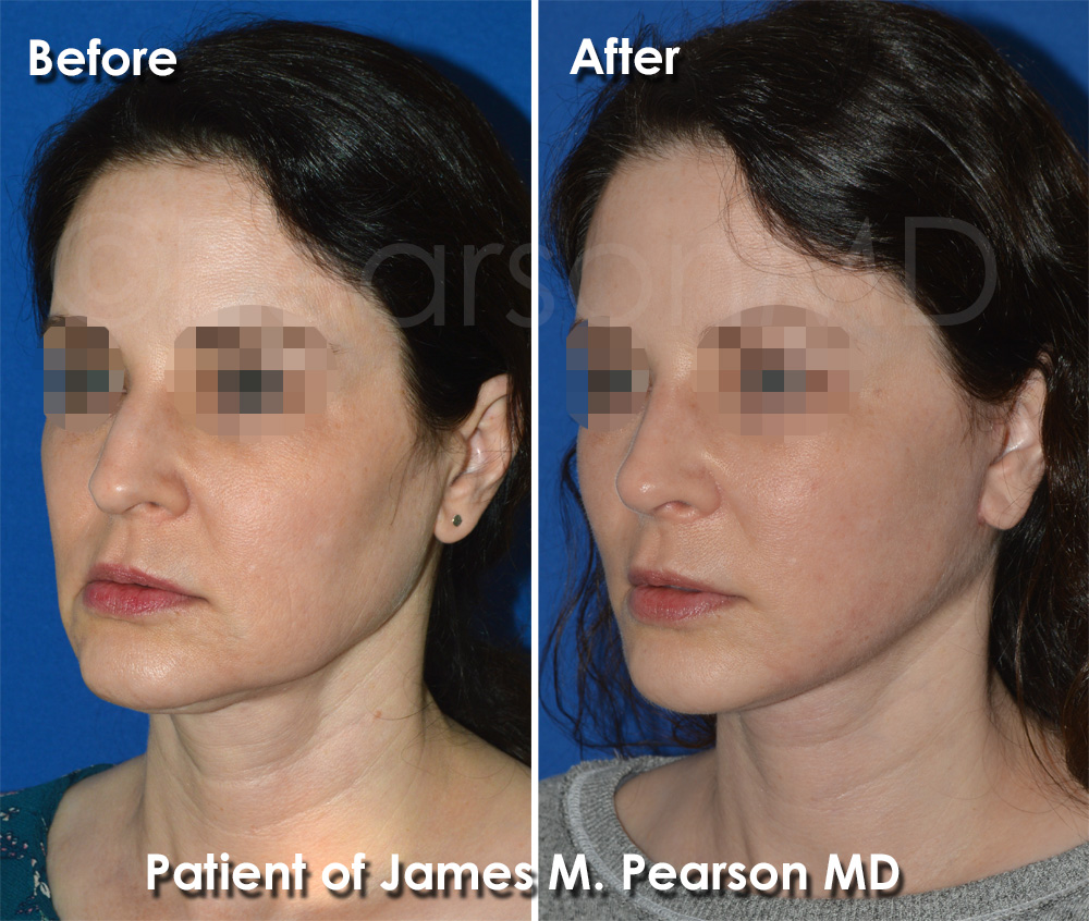 Manhattan Beach Facelift