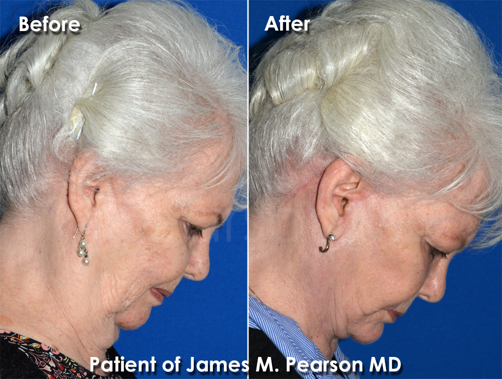 Dr. Pearson Facelift