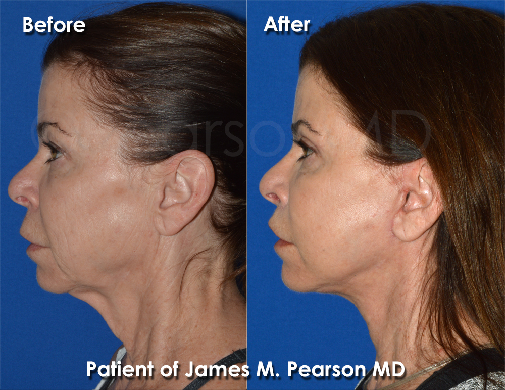 Pearson Neck Lift