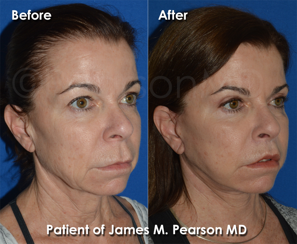 Photo Pearson Plastic Surgery