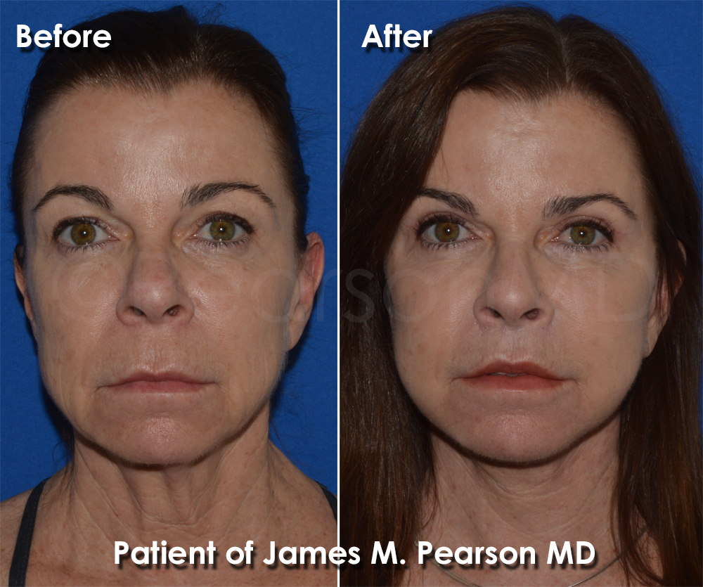 Dr. Pearson Facelift
