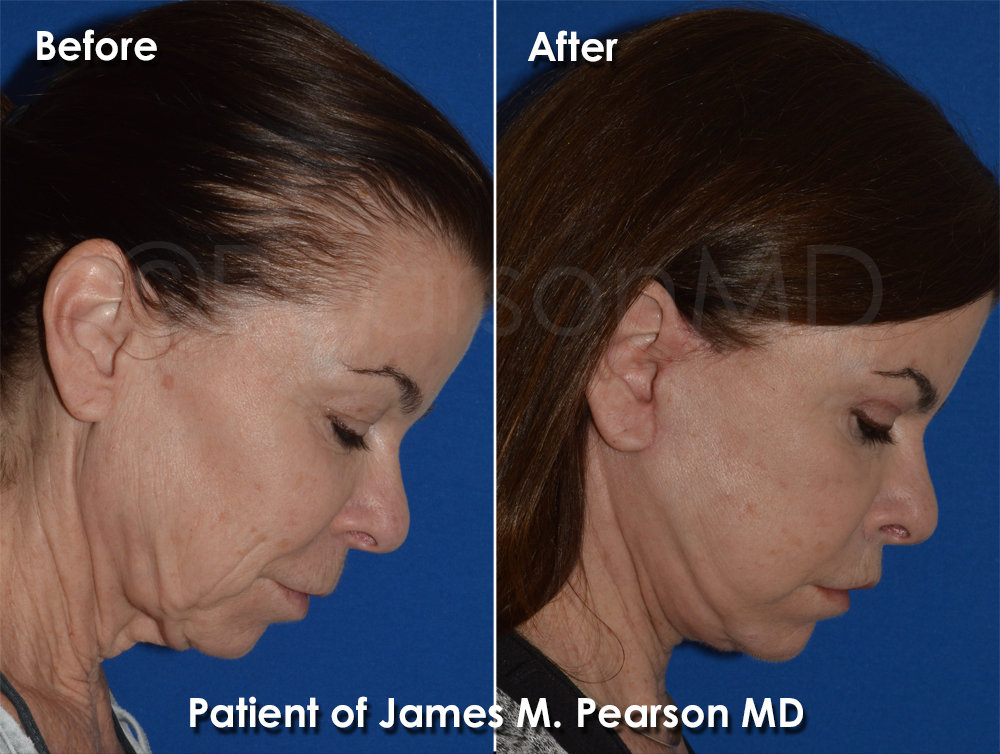 Photo Dr. Pearson Facelift