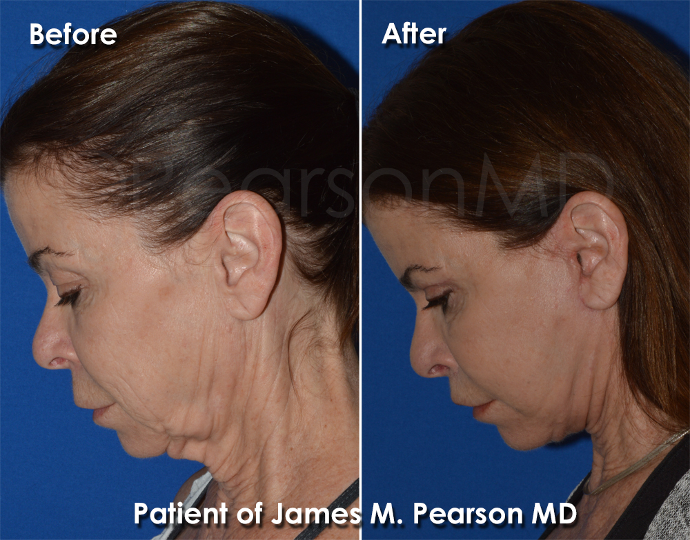 Photo Pearson Cosmetic Surgery