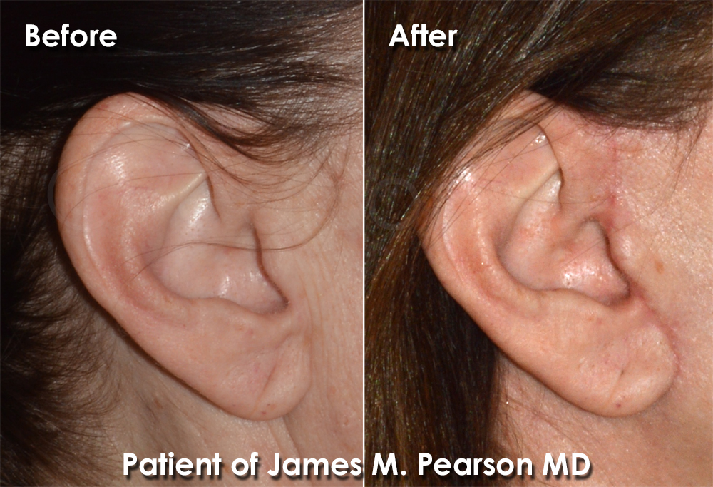 Photo Facelift Dr. James Pearson Facial Plastic Surgery Photo Dr. Pearson Facelift