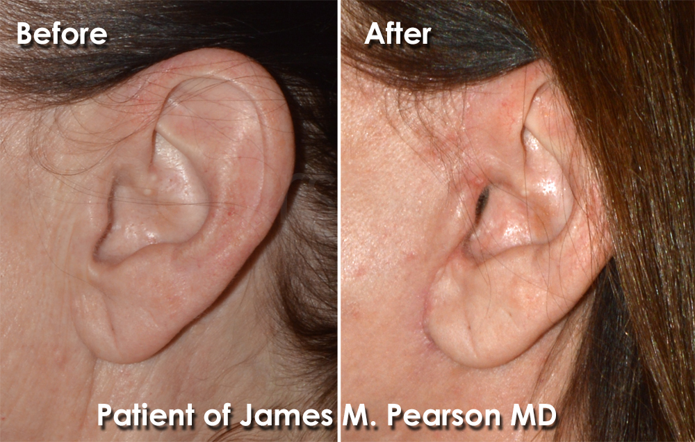 Photo Facelift Dr. James Pearson Facial Plastic Surgery Photo Pearson Plastic Surgery