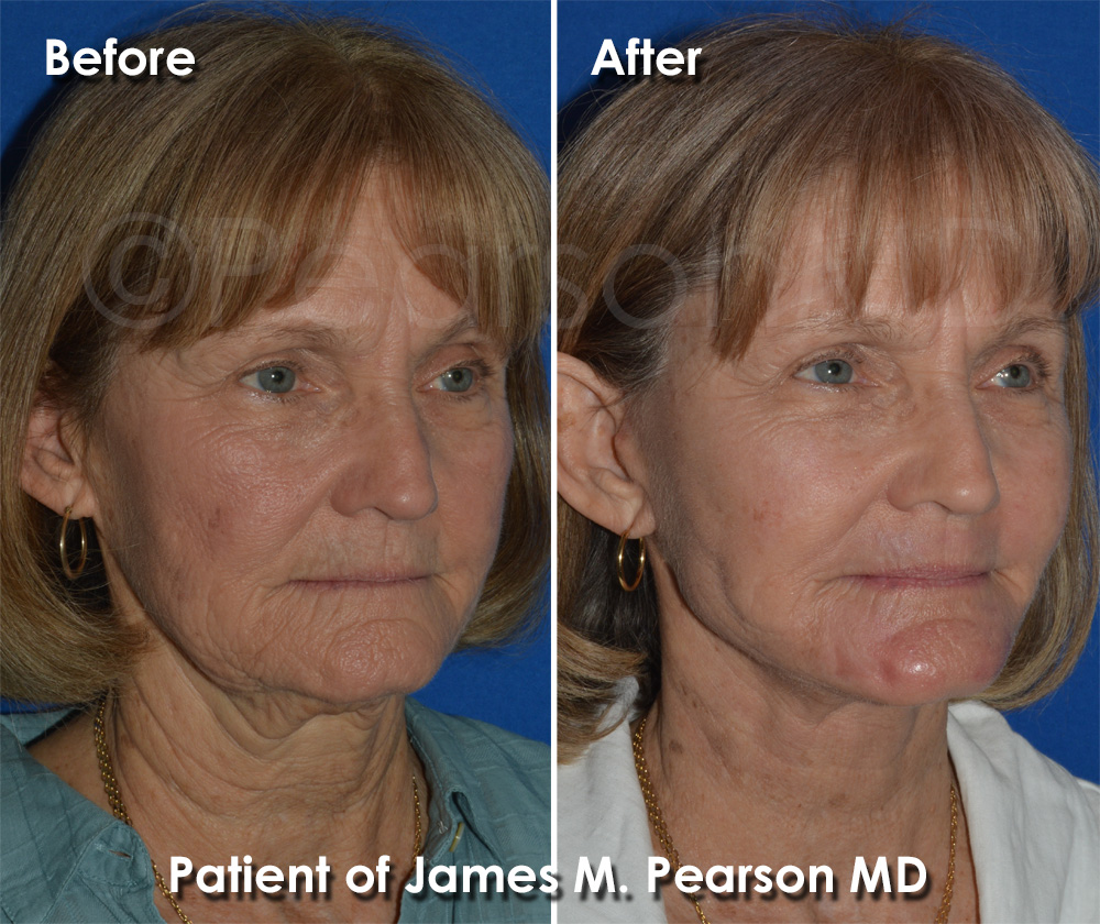 Pearson Cosmetic Surgery