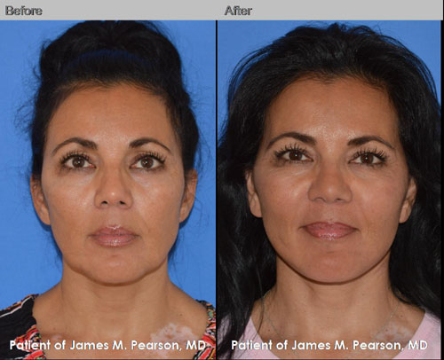 Dr. Pearson Facelift Neck Lift Photos Pearson Facelift Photos