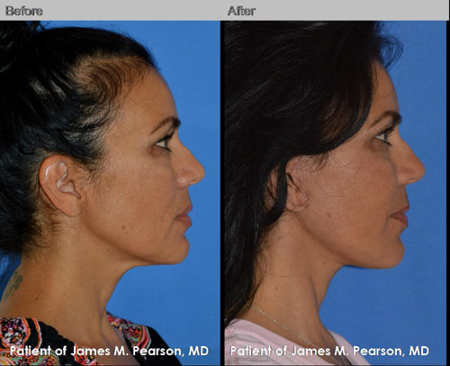 Dr. Pearson Facelift Neck Lift Photos Pearson Facelift Photos