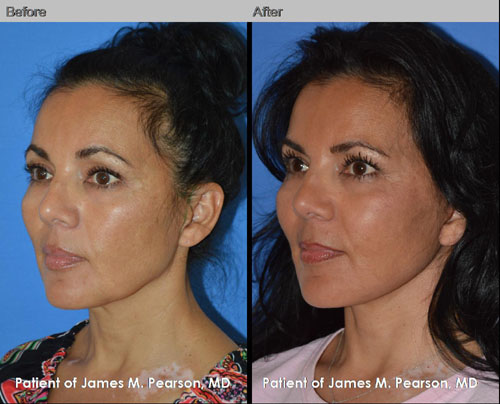 Dr. Pearson Facelift Neck Lift Photos Pearson Facelift Photos
