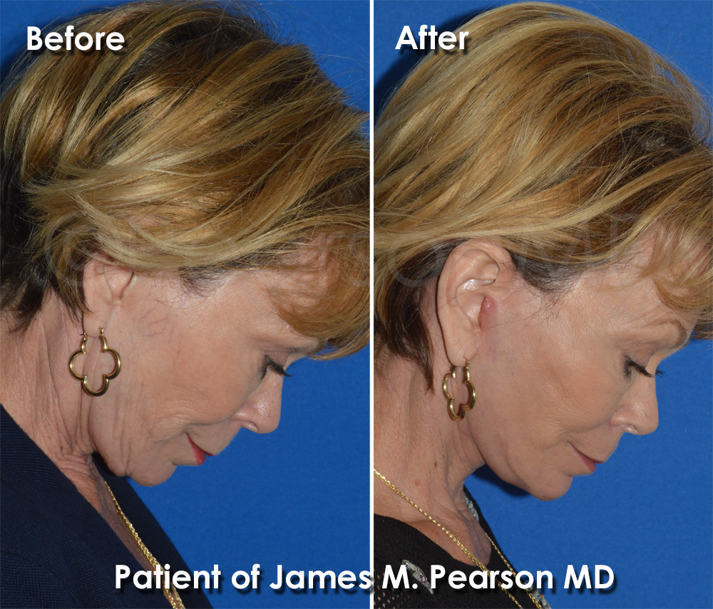 Pearson Plastic Surgery
